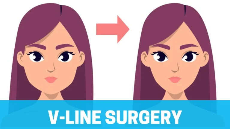 V-Line Surgery -- Everything You Need To Know