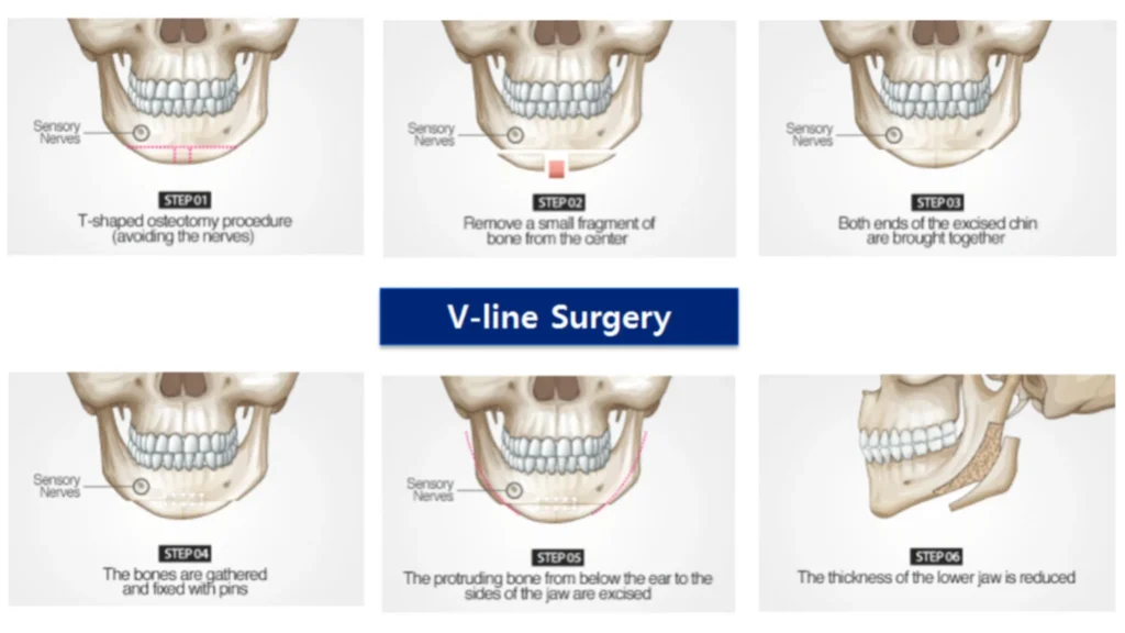 V-Line Surgery -- Everything You Need To Know