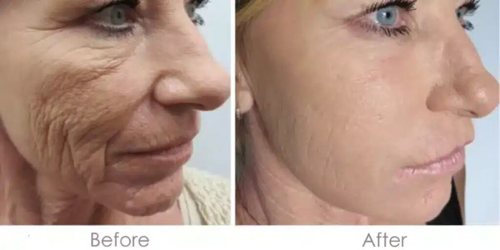 Micro needling Before and After Wrinkles