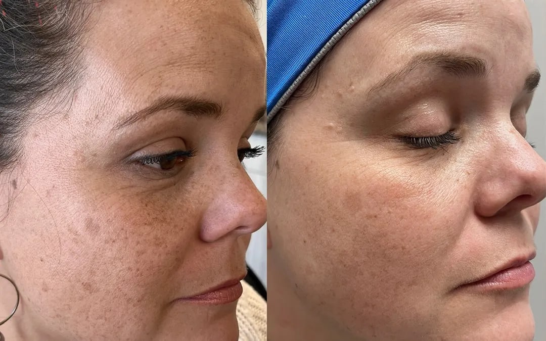 How to Identify Micro needling Before and After Wrinkles